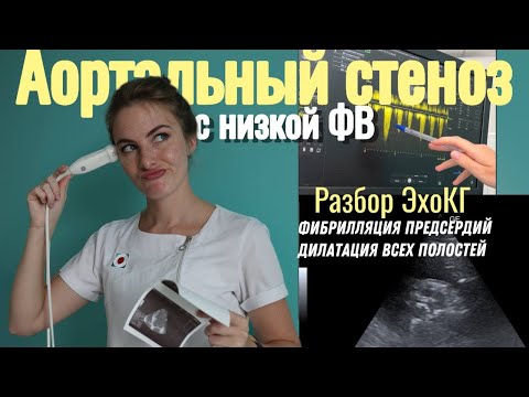 Видео: Эхокардиография. Разбор случая с АОРТАЛЬНЫМ СТЕНОЗОМ, низкой ФВ, ФП, ДИЛАТАЦИЕЙ всех полостей.