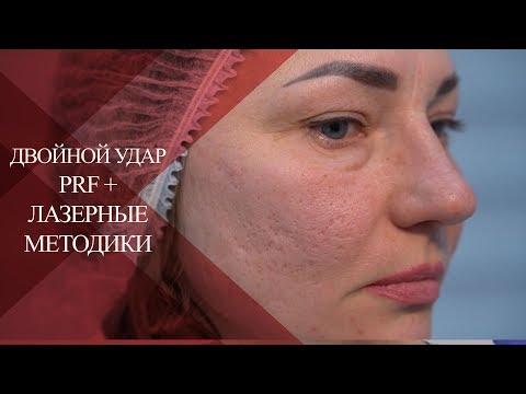 Видео: 💉Лазерная шлифовка глубоких постакне рубцов Fraxel и PRP PRF | Коррекция рубцов и шрамов аутоплазмой
