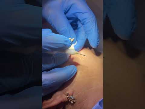 Видео: Удаление атеромы на щеке