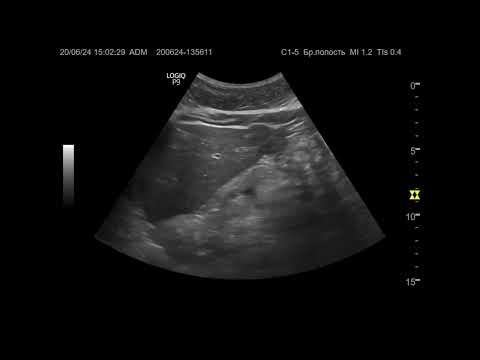 Видео: Ультразвуковая диагностика (УЗИ). Доктор Иогансен. Видеопримеры. Выпуск 86. Опухоль печени (4).
