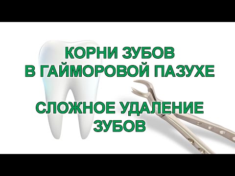 Видео: СЛОЖНОЕ УДАЛЕНИЕ ЗУБОВ | КОРНИ ЗУБОВ В ГАЙМОРОВОЙ ПАЗУХЕ | КЛИНИКА "33 ЗУБ" | СТОМАТОЛОГИЯ СПБ