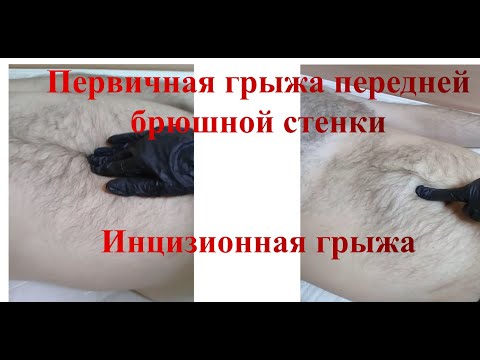 Видео: Первичная грыжа передней брюшной стенки / Инцизионная грыжа