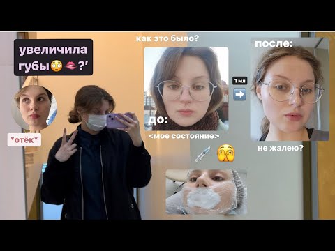 Видео: увеличила губы?! и что со мной стало🧐 сколько стоила процедура? как все прошло