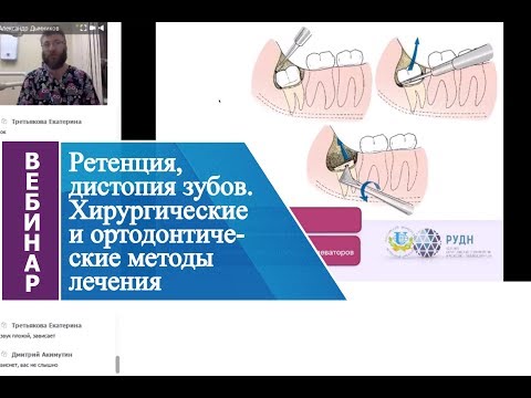 Видео: Вебинар «Ретенция, дистопия зубов. Хирургические и ортодонтические методы лечения».