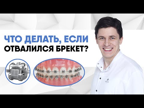 Видео: Что делать, если отвалился брекет?