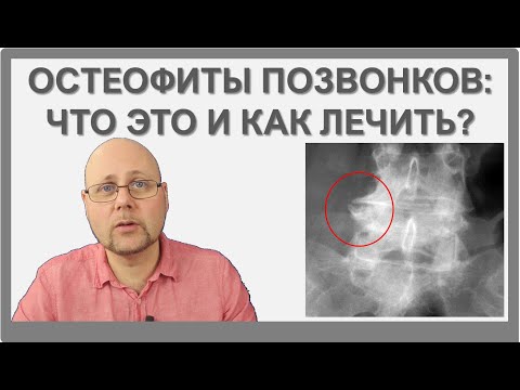 Видео: Остеофиты позвонков: самое главное