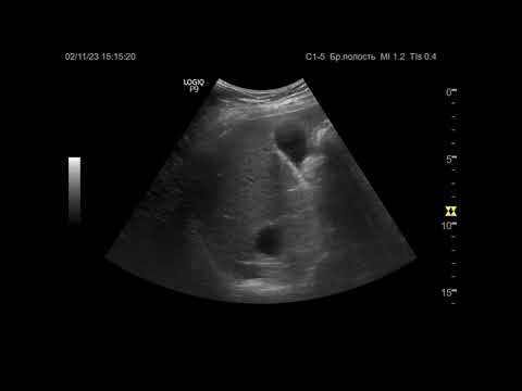 Видео: Ультразвуковая диагностика (УЗИ). Доктор Иогансен. Видеопримеры. Выпуск 50. Кисты печени (2).