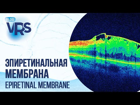 Видео: Эпиретинальная мембрана | Epiretinal membrane