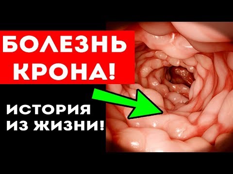 Видео: Вот как ПИТАНИЕ ПОБЕДИЛО серьезный ДИАГНОЗ! Воспаление кишечника ВЗК (болезнь Крона)