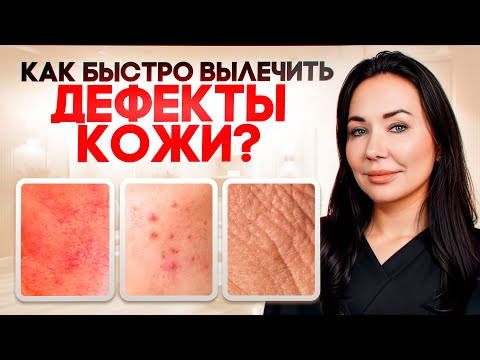 Видео: Фотодинамическая терапия. Как убрать акне, розацеа и другие дефекты кожи?