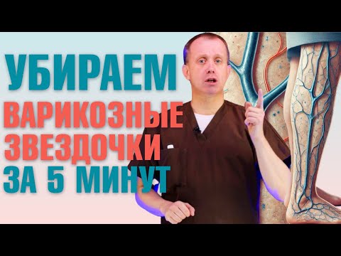 Видео: Варикоз на ногах и сосудистые звездочки? Как себе помочь