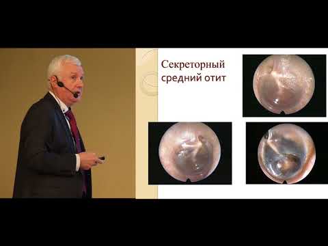 Видео: Діагностика секреторного отиту