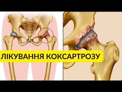 Видео: Що таке коксартроз? Комплекс домашніх вправ при коксартрозі