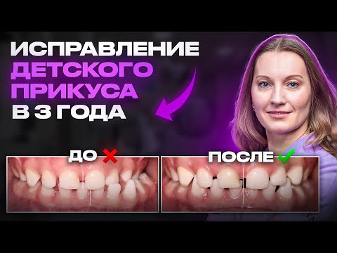 Видео: КАК РАСПОЗНАТЬ РАНЕЕ НАРУШЕНИЕ ПРИКУСА У ДЕТЕЙ?