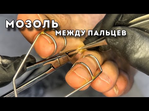 Видео: Корешковая мозоль справа и слева на пальцах в месте соприкосновения, трения и давления