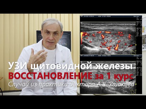 Видео: Лечение и УЗИ щитовидной железы. Гипертиреоз. Восстановление структуры и кровотока || Доктор Ушаков