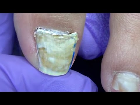 Видео: Лишилась НОГТЯ На Ноге 😫