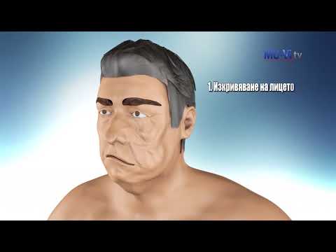 Видео: Инсулт. Времето е мозък / Stroke. Time is brain