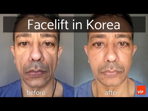 Видео: Подтяжка лица в Корее, Центр пластической хирургии VIP
