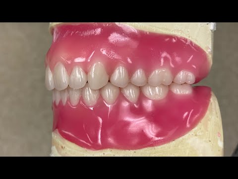 Видео: 🔴ПРЯМО В ПРЯМОМ ЭФИРЕ: Установка зубов: Депиляция зубов воском #waxbae #зубныепротезы #воск