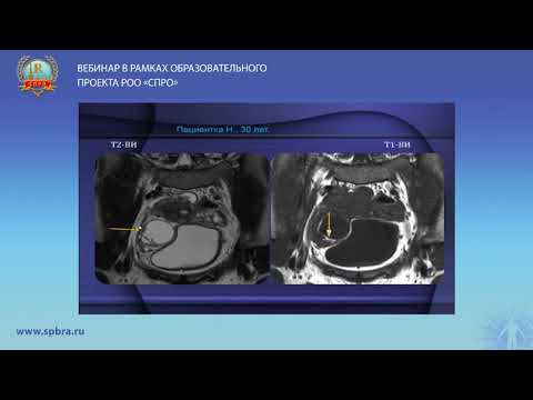 Видео: Юхно Е.А. Сложности оценки проведенного лечения по МРТ при раке яичника