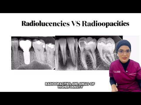 Видео: Как читать рентгеновские снимки зубов