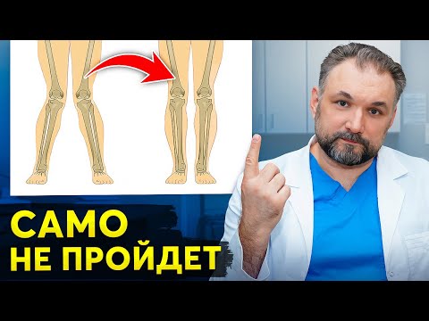 Видео: Главные признаки развития О и Х образных ног! Останови, пока не поздно