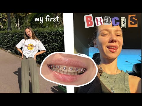 Видео: поставила брекеты | мои ощущения на второй день | какие брекеты выбрать?
