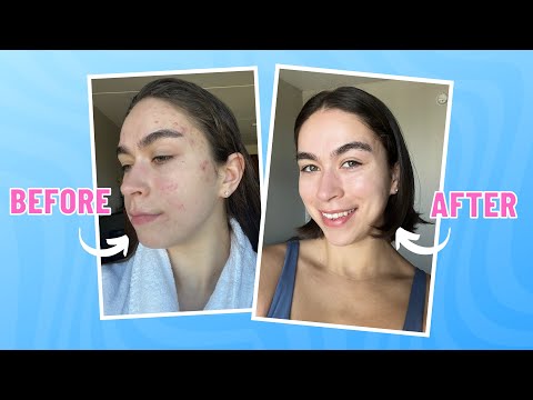 Видео: Что нужно знать перед приемом Аккутана | фотографии до и после, побочные эффекты и многое другое