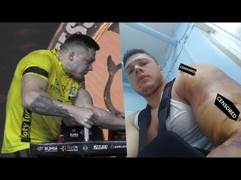 Видео: My story, how I broke my arm in armwrestling! Как я сломал руку в армрестлинге!