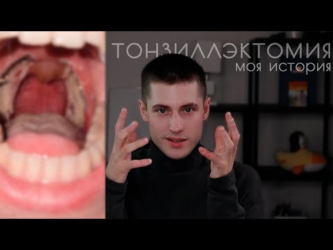 Видео: Мой опыт удаления миндалин. Тонзиллэктомия. Боли, страдания, радость