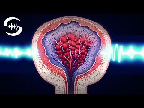 Видео: Помощь при геморрое: лечите боль и геморрой с помощью частот.