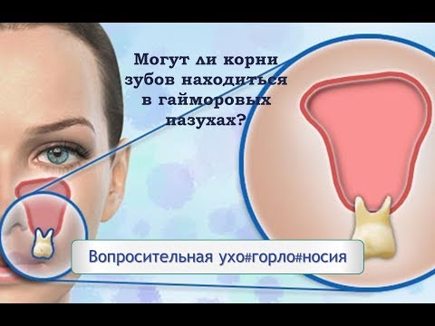 Видео: Могут ли корни зубов находиться в гайморовых пазухах?