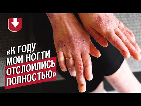 Видео: Девушка с буллезным эпидермолизом: Саша | ВОПРЕКИ