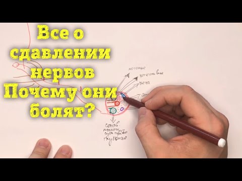 Видео: Как сдавливаются корешки и нервы?