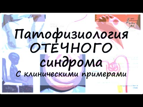 Видео: Отеки: причины и примеры клинических случаев
