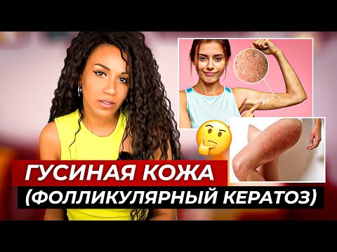 Видео: ГУСИНАЯ КОЖА // Фолликулярный кератоз: простые рекомендации  как сделать кожу гладкой