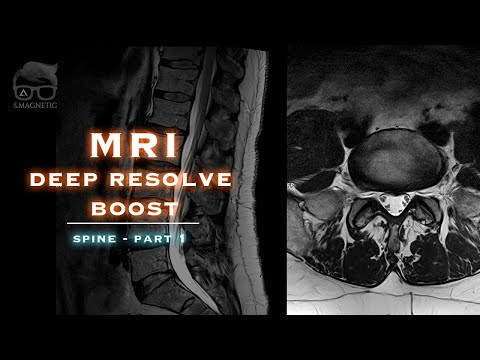 Видео: МРТ DEEP RESOLVE BOOST – ПОЗВОНОЧНИК – ЧАСТЬ 1