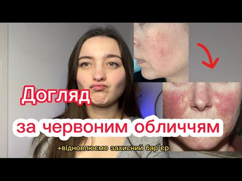 Видео: Розацеа/ Купероз/ Чутлива шкіра.Правила догляду. Відновлюємо захисний бар‘єр.
