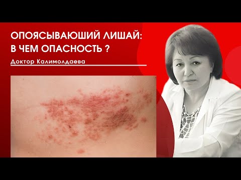 Видео: ОПОЯСЫВАЮЩИЙ ЛИШАЙ: В ЧЕМ ОПАСНОСТЬ?