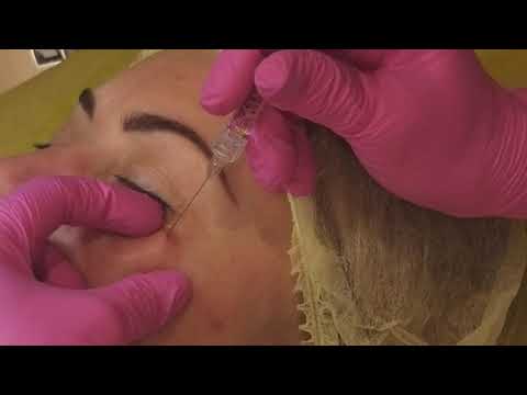 Видео: Периорбитальная зона. Канюля(фрагмент)