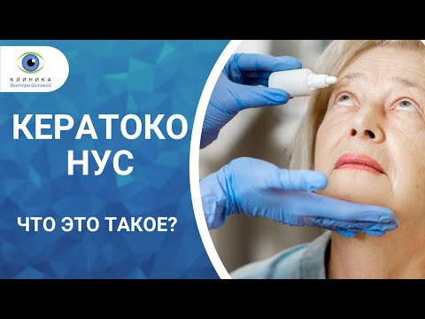 Видео: Кератоконус -  что это за болезнь? Причины, симптомы и лечение!