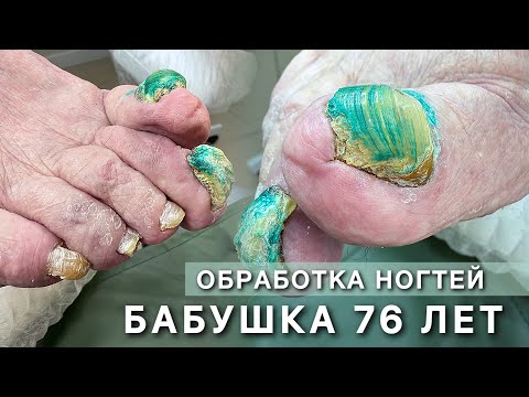 Видео: Бабушка 76 ПРИВЁЛ ВНУК. Не может подстричь ногти. ОНИХОГРИФОЗ