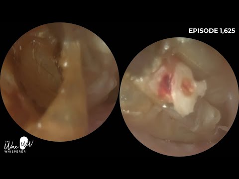 Видео: Эпизод 1625 | Экстремальное удаление кожи уха у пациента с обтурирующим кератозом