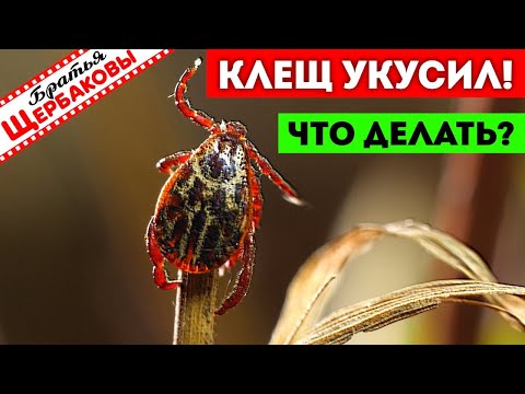 Видео: КЛЕЩ УКУСИЛ… Что делать? ТРИ лучших СПОСОБА спасения!