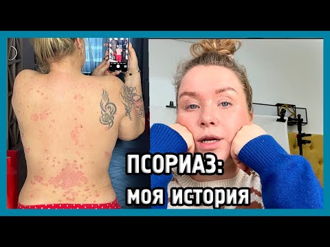 Видео: ПСОРИАЗ: кожа, в которой я живу