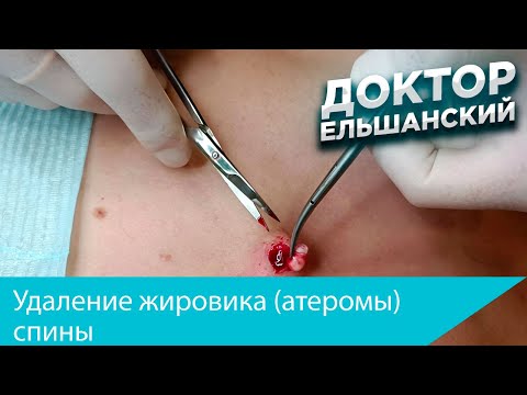 Видео: Удаление жировика (атеромы) спины