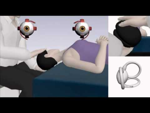 Видео: Методы диагностики и лечения доброкачественного пароксизмального позиционного головокружения | NEJM