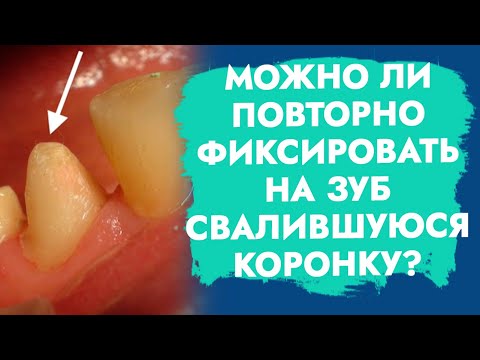 Видео: С зуба свалилась коронка. Что делать?