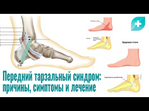 Видео: Передний тарзальный синдром: причины, симптомы и лечение